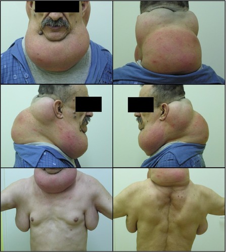 Figure 2 Patient with Madelung’s disease.