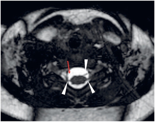Figure 2. Axial BFFE MR image (0.5 mm) in a 4-month-old girl (patient 26) with brachial plexus birth injury on the right side. Partial avulsion of C8 root: ventral root is avulsed (red arrow), dorsal C8 root is intact (arrowhead). Left C8 nerve roots are normal (arrowheads).