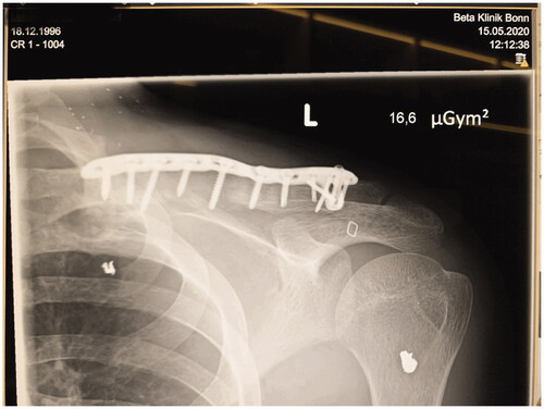 Figure 4. X-ray imaging 8 weeks after surgery shows good embedding of the bone graft and regular plate and screw positions.