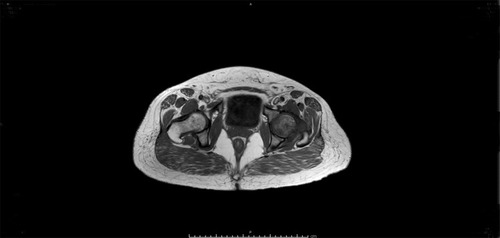 Figure 2 T1-weighted MRI: Axial view demonstrating bone marrow edema of the left hip.