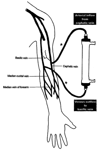 Figure 1. Direct venopuncture to cephalic vein in the process of arterial inflow to dialyzer and venous outflow from dialyzer to basilic vein as temporary vascular access.