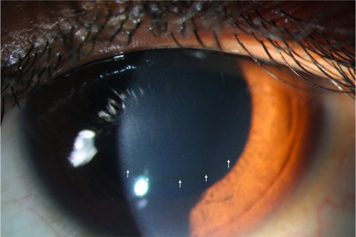 Figure 5 Slit-lamp photograph of the same eye as in Figures 3 and 4, showing Fleischer’s ring (white arrows).