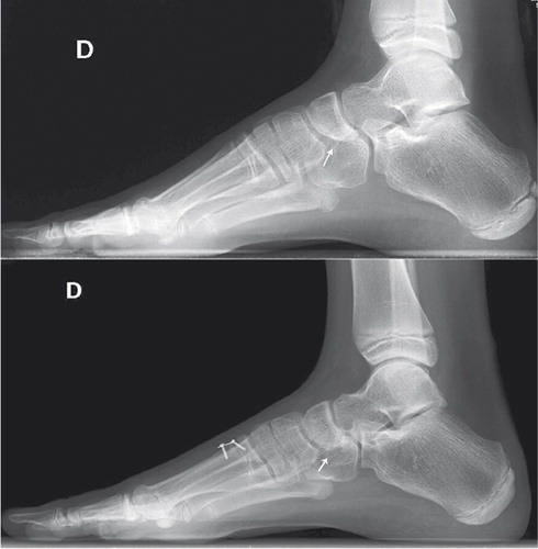 Figure 6. Despite the plate being located at the base of the 1st metatarsal, part of the correction occurs on the surrounding bones. The arrow points at the changes seen at the navicular bone in a patient 2 years after surgery. Note the enlargement of the navicular on its plantar aspect.