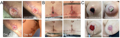 Figure 2. Treatment of small dermal wounds with topical application of hypoxia preconditioned serum (HPS) obtained from the patient’s peripheral blood. (a) Image panel showing a wound healing complication in the right inner thigh after a vertical thigh-lift procedure in a 30-year-old female smoker. Initial wound surface area was 6 cm2. Complete wound closure was achieved at 60 days post-debridement and initiation of treatment with daily application of an emulsion containing 10% HPS. (b) Image panel showing a wound healing complication at the lower central abdomen after an abdominoplasty procedure in a 40-year-old female smoker. Initial wound surface area was 4 cm2, while complete wound closure was achieved at 60 days post-debridement and initiation of treatment with daily application of an emulsion containing 10% HPS. (c) Image panel showing a wound healing complication (nipple-areola complex necrosis) in the right breast following a breast-lift procedure in a 22-year-old female patient. Initial wound surface area was 9 cm2. Complete wound closure was achieved at 60 days post-debridement and initiation of treatment with daily application of an emulsion containing 10% HPS. Debridement refers to surgical excision of necrotic tissue deep-down to well-perfused layers. The number of days indicated is counted from the time point of first treatment application. Bars = 1 cm.