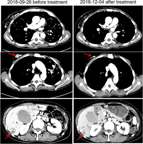 Figure 2 Changes of images before and after treatment. The red arrows indicate the metastatic tumor.