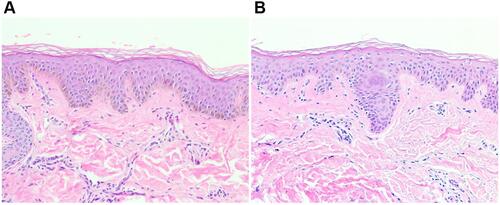 Figure 17 Hematoxylin and eosin stain (×10 magnification) of the scalp of patient 13 (African descent) showing normal orthokeratosis in the occipital area (A) compared with compact orthokeratosis of a thicker epidermis in the parietal scalp (B).