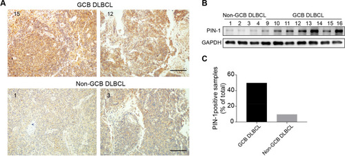 Figure 1 PIN-1 expression is enhanced in the GCB subtype of DLBCL. (A) Representative images of IHC showing PIN-1 expression in the GCB (upper) and non-GCB (lower) subtypes of DLBCL (scale bar = 200 μm). (B) PIN-1 protein levels in a panel of lymphoma tissues of the GCB (right) and non-GCB (left) DLBCL subtypes were measured by WB. Shown are representative immunoblots from 3 assays. (C) PIN-1 staining was more intense in GCB (n = 35) than in non-GCB DLBCL samples, as shown by IHC (n = 38) (P < 0.001).