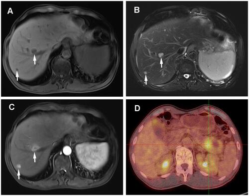 Figure 2 Preoperative MRI and PET/CT examination of the reported case. (A) The lesion of liver (one in the S6 of liver, another in the S8, white arrow) was hypointense in T1-weighted imaging. (B) The irregular lesion (white arrow) has slightly hyperintense in T2-weighted imaging, (C) significantly enhanced lesions in the arterial dominant phase, (D) PET/CT presented hypermetabolic nodule measuring 2.3×1.4 cm (SUVmax=6.2) in pancreatic tail.