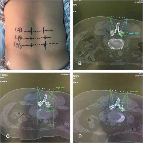 Figure 2 (A) Needle-knife insertion point on the body surface: (B) angle and depth for L2/3; (C) angle and depth for L3/4; (D) angle and depth for L4/5.