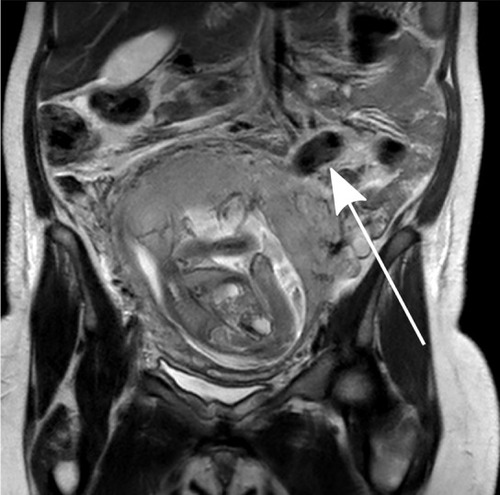 Figure 1 MRI of placenta increta (third pregnancy).