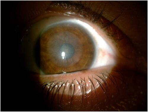Figure 1 Three months after implantation shows wrinkles of the lenticule and hazy graft.
