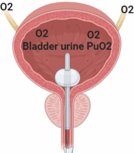 Figure 3. Oxygen flow from the ureters to the urinary bladder and oxygen-sensing probe passing through the urinary catheter with its tip located inside the urinary bladder to measure bladder PuO2