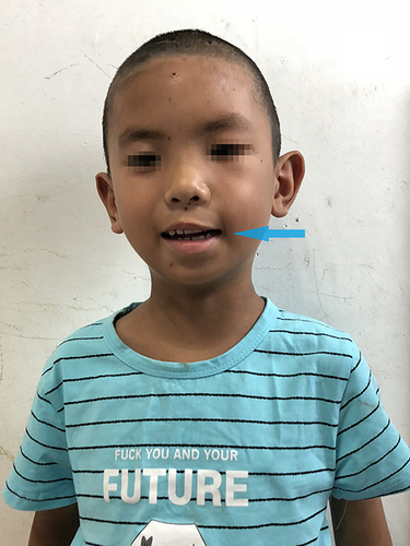 Figure 4 The boy is smiling after facial paralysis treatment (The arrow shows a significantly improvement of crooked mouth after treatment).