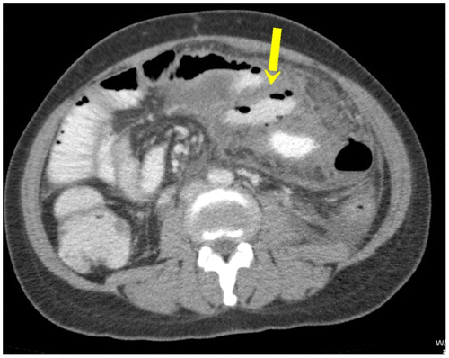 Figure 8b: SBO in a known patient with tuberculosis complicated by perforation. Extraluminal contrast filled collection (yellow arrow)