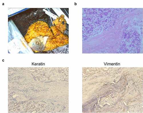 Figure 1. Representative images of postoperative samples from a 68-year-old Chinese woman with an adenomyoepithelioma (AME). (a) An image of AME tissues. (b) A typical image of hematoxylin and eosin-stained postoperative tissues. Scale bar = 100 μm. (c) Immunohistochemistry assay for keratin and vimentin expressions. Scale bar = 100 μm