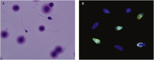 Figure 2  (A) Sperm DNA fragmentation assessed by sperm chromatin dispersion test. (B) Sperm DNA fragmentation assessed by TUNEL assay.