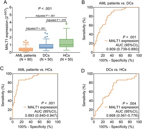 Figure 1. MALT1 was reduced in AML patients compared to HCs and DCs. Comparison of MALT1 expression among AML patients, DCs, and HCs (A). ROC curve analyses of MALT1 expression in distinguishing AML patients from DCs (B); AML patients from HCs (C); DCs from HCs (D).