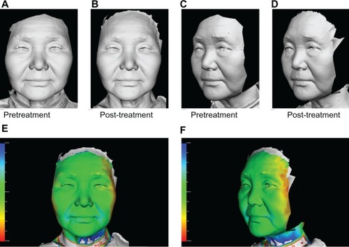 Figure 5 A 65-year-old Japanese woman (A and C) pretreatment and (B and D) 60 days post-treatment, and (E and F) three-dimensional color schematic representation. Two treatments with a one-month interval between treatments were performed with four passes at 50 J/cm2 (100 shots). Significant improvements were noted in the gray image and three-dimensional color schematic representation. Volume reduction was 2.097 mL.