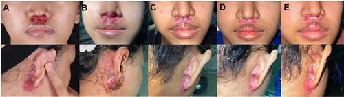 Figure 2 Follow-up of treatment. Compared to the wounds (A) before procedure, the epithelization was observed (B) at week 3 and improved (C) at week 5. Further improvement of wound closure was seen (D) at week 14, but some areas were easily detached as seen in (E) week 15. The wound closure exceeded 70% of the total area.