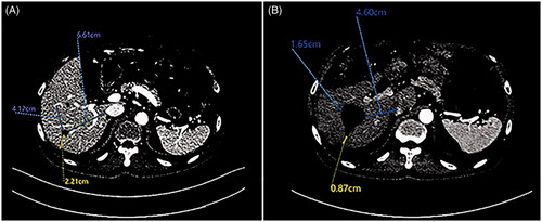 Figure 3. Example of microwave ablative margin measurement in a 63-years old man with a 1.6-cm colorectal liver metastasis in segment 6. (A) Axial portal venous phase computed tomography (CT) image shows the tumor before ablation; distances were measured from the edges of the tumor to the chosen landmarks. (B) Axial portal venous phase CT image obtained 7 weeks after ablation shows the ablation defect; the same distances were measured from the edge of the ablation defect to the same landmarks. The corresponding distances were subtracted, and the smallest value was chosen as the minimal margin—that is 22.1 mm–8.7 mm = 13.4 mm.