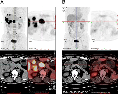 Figure 1 PET/CT revealed focal hypermetabolism in the lesions corresponding to the nodules observed in the CT scans before and after the combined treatment. The PET/CT scans conducted in January 5, 2021 (A) and September 23, 2021 (B).