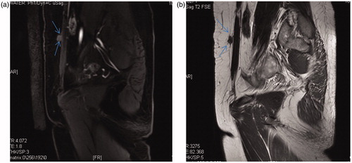 Figure 4. (a) T1-weighted MRI of an AWE mass before the HIFU procedure. (b) T2-weighted MRI of an AWE mass before the HIFU procedure.