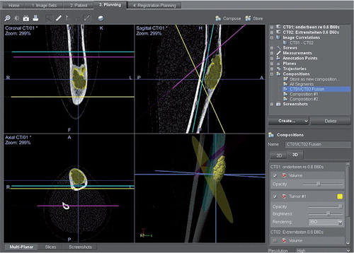 Figure 1. Preoperative planning screen. The tumor has been colored, to discern it more easily during the operation. The resection planes have been planned using the coronal, axial, and sagittal view. These planes are copied to the pre-matched CT of the donor bone.