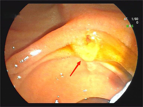 Figure 1 Endoscopic retrograde cholangio-pancreatography (ERCP) image. The common bile duct shows purulent secretions (marked by red arrow).