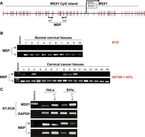 Figure 2 MSX1 was methylated in primary cervical tumors.