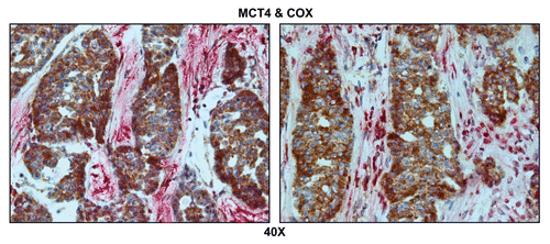 Figure 6 Visualizing the “reverse Warburg effect” by double labeling with MCT4 and COX activity staining. Frozen sections of human breast cancer-positive lymph nodes were subjected to COX activity staining (brown color) and immunostaining with MCT4 antibodies (red color). Slides were then counterstained with hematoxylin (blue color). Note that MCT4 staining is predominantly localized to the cancer-associated lymph node stroma. In contrast, COX activity is strongly associated with the metastatic breast cancer cells. Two representative images are shown. Original magnification, 40x.