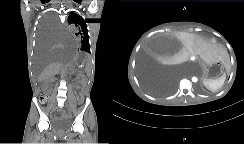 Figure 1 Computed tomography of the chest, abdomen and pelvis: right pleura, was filled with large amount of fluid, causing compression and atelectasis of the right lung and displacement of the mediastinal organs to the left.