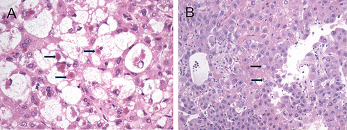 Figure 5 Histological features of steatohepatitic HCC. (A) Tumor cells with a group of ballooning hepatocytes with enlarged, rounded, rarefied cytoplasm, with some hepatocytes containing Mallory–Denk bodies (marked by arrow) (hematoxylin and eosin stain, original magnification ×400). (B) Glycogenated nuclei can be seen in some tumor cells (marked by arrow) (hematoxylin and eosin stain, original magnification ×200).