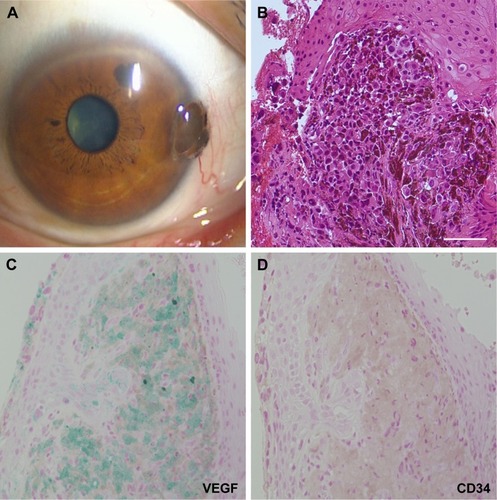 Figure 1 A representative case of conjunctival melanoma in a 65-year-old female.