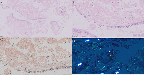 Figure 5 Pathological findings of bronchial biopsies: (A) (HE×100), (B) (HE×400): Low and high magnification views showing abundant amorphous eosinophilic material depositing under the epithelium of bronchial mucosa. (C) (Congo red staining ×400): Congo red stain highlight the dense accumulation of brick red amyloid material in bronchial mucosa; (D) (Congo red staining ×400): Congo red stain typically shows apple-green birefringence in polarized light.