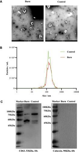 Figure 1 Characterization of plasma exosomes from burn patients and control group. (A) Visualized exosomal morphology in transmission electron microscopy (TEM). Scale bar = 200 nm. (B) Size distribution of plasma exosomes by nanoparticle tracking analysis (NTA). (C) Western blotting (WB) analyses of the exosome protein marker CD63 and the endoplasmic reticulum protein marker Calnexin.