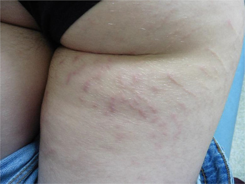 Figure 4 Severe striae distensae in a 16-year-old girl with psoriasis. The patient received treatment with topical steroids for a long time.