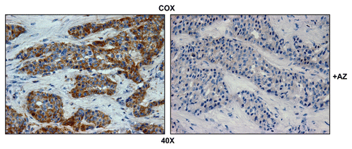 Figure 3 Mitochondrial activity staining is ablated with metabolic inhibitors. Frozen sections of human breast cancer-positive lymph nodes were subjected to COX activity staining (brown color). Slides were then counterstained with hematoxylin (blue color). Note that sodium azide (+AZ; 1 mM; a Complex IV inhibitor) effectively abolished the COX activity staining.
