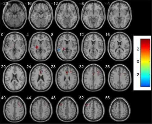 Figure 2 Abnormal resting-state FC in the SN in schizophrenia patients at baseline.
