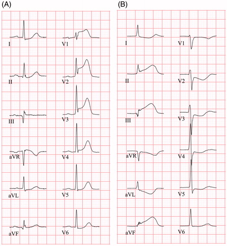 Figure 2. ECGs (25 mm/s) from two STEMI patients. (A) ECG shows concave ST elevation in V1 – V4 and ST depression in aVL, I and II. ST elevation is present in aVR. PR depression is absent in both limb leads and chest leads. Terminal QRS distortion is present in leads V2 and V3 (absent S and J wave in leads with ST elevation (Rs configuration)). (B) ECG shows concave ST elevation in inferior leads (II, aVF, III) with reciprocal ST depression in leads aVL and I, as well as precordial leads. PR depression is absent in both limb leads and chest leads. Terminal QRS distortion is present in aVF and III (ST elevation ≥50% of R-wave amplitude).