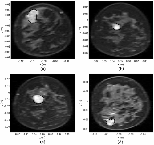Figure 7. Coronal MR breast images used in the hyperthermia simulations (a) patient data I, (b) patient data II, (c) patient data III, (d) patient data IV (black contours indicate tumor sites).