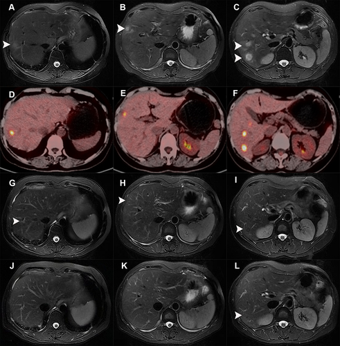 Figure 1 The radiological manifestations of liver nodules during the disease process. (A-C) MR images (T2-weighted) showed several round-like hyperintense nodules (white arrows) in the right lobe of the liver. (D-F) PET-CT displayed multiple lesions with increased uptake of nuclear species in the liver. (G-I) MR images (T2-weighted) showed the size of the nodules (white arrows) in the liver was smaller than before after 2 months of antifungal treatment. (J-L) MR images (T2-weighted) showed the liver nodules (white arrows) almost disappeared after 6 months of treatment.