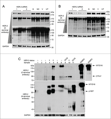 Figure 3. HER2 proteins expressed in breast tumor tissues and SKBR3 cells. (A and B) Reduction of HER2 protein expressed by SKBR3 cells was achieved via RNA interference using 2 different siRNA sequences (lanes 1–4). Four controls comprising a positive transfection control (GAPDH siRNA (G)), a negative scrambled sequence control siRNA (NC), a vehicle only control (V) and untreated cells (UT) were included (lanes 5–8). Levels of HER2 proteins were determined by immunoblotting using C-terminal (A) and N-terminal (B) anti-HER2 antibodies (C) Immunoblotting using C-terminal and N-terminal anti-HER2 antibodies and protein extracted from tumor tissue samples and SKBR3 cells. GAPDH was used as a loading control.