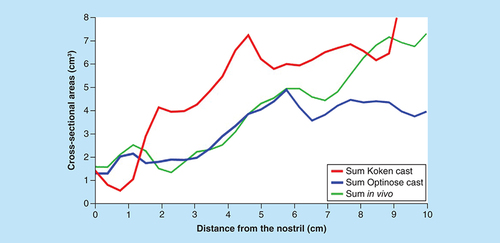 Figure 5. Acoustic rhinometry curves in vivo and in the two casts.Summed dimensions as a function of distance along the acoustic pathway in the two casts and in vivo in the subject from whom the Optinose cast was generated as measured by acoustic rhinometry.