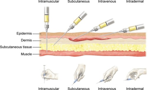 Figure 6 Structure of the skin and subcutaneous layers and common routes of parenteral drug administration.