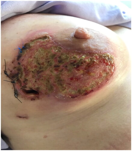 Figure 3. (POD13) 24h after the establishment of the diagnosis of pyoderma gangrenosum and starting steroids, we can see the disappearance of erythema and subsequently pain.