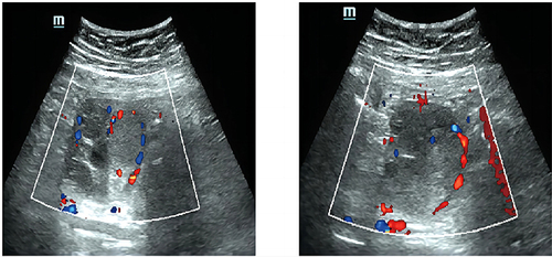Figure 1 Abdominal ultrasound indicating a mixed echogenic mass in the right enlarged ovary without clear boundary. The dotted line surrounds blood flow signals detected in the interior and surrounding tissue.