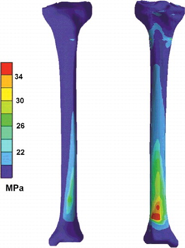 Figure 6. Sample 3D result of von Mises stress distribution (MPa) on anterior (left) and posterior (right) sides of tibia.