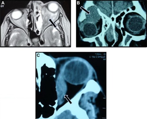 Figure 1 Imaging patterns of orbital metastasis.