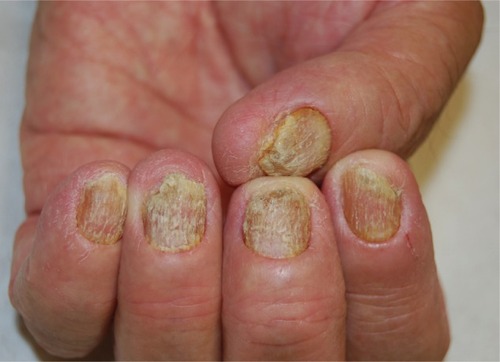 Figure 1 Nail matrix psoriasis of fingernails.