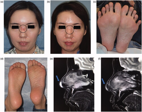 Figure 1. (a) Findings on the first examination: Redness and capillary dilatation were observed in the nose root region over the dorsum of the nose, indicated by the circle. (b) 1 year after surgery: Redness and capillary dilatation in the nose root region disappeared, indicated by the circle. (c) First examination at our hospital: Photograph of the sole. Pustules associated to scaling plaques and some fissures in the palmoplantar area were noted. (d) 1 year after surgery: Photograph of the sole. No recurrence of palmoplantar pustulosis was noted at 1 year after surgery. (e) MRI: A water-soluble implant remained in the region, indicated by the arrow. (f) 1 year after surgery: Postoperative reactions were noted in the region, indicated by the arrow.